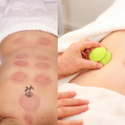 Kuivakuppaus – lempeä apu stressiin, kiputiloihin ja kireyksiin